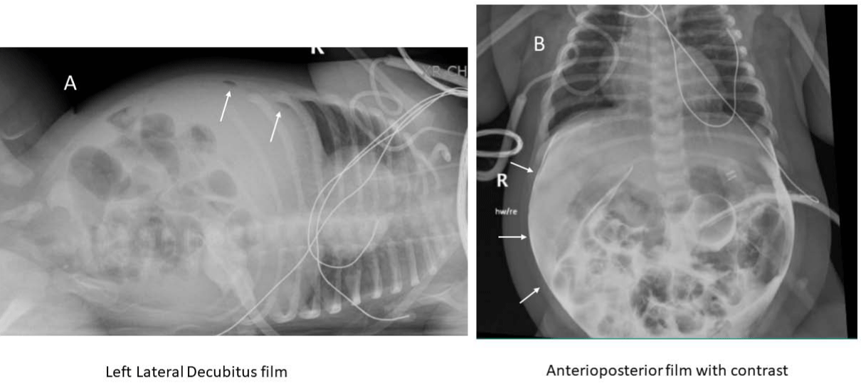 White Peritoneum white-peritoneum