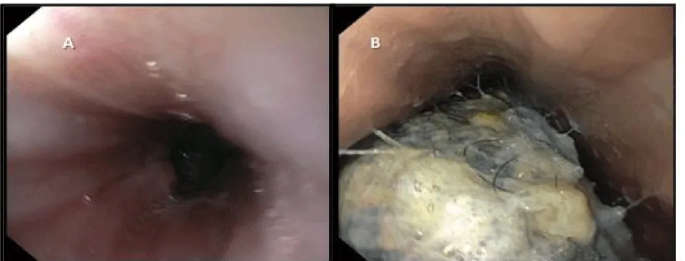 Giant Chronic Gastric Trichobezoar: Total Gastrectomy
