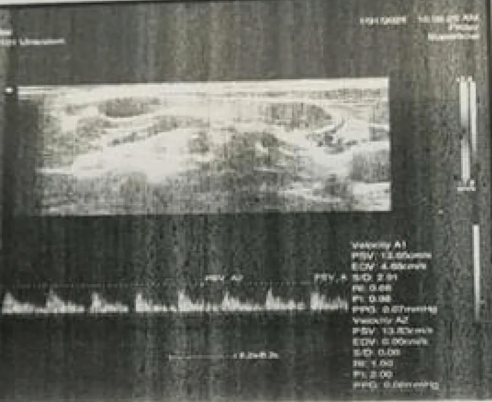 A Rare Case of Kikuchi-Fujimoto Disease