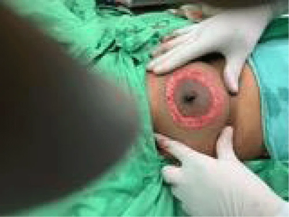 Novel Oncoplastic Surgery for Long-Term Outcome and Prediction of Breast Cancer Survival beyond Serial Axillary Dissection – A Prospective Study