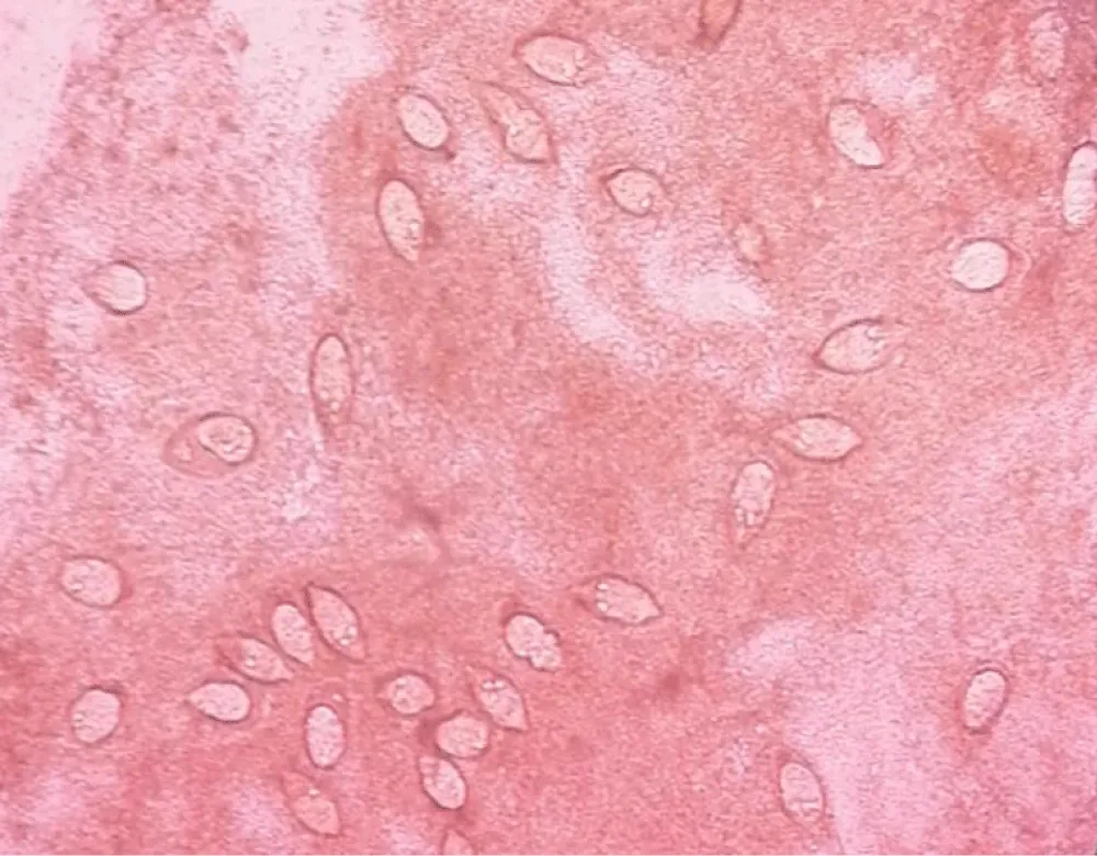Genital Schistosomiasis - Induced Infertility: A Case Report