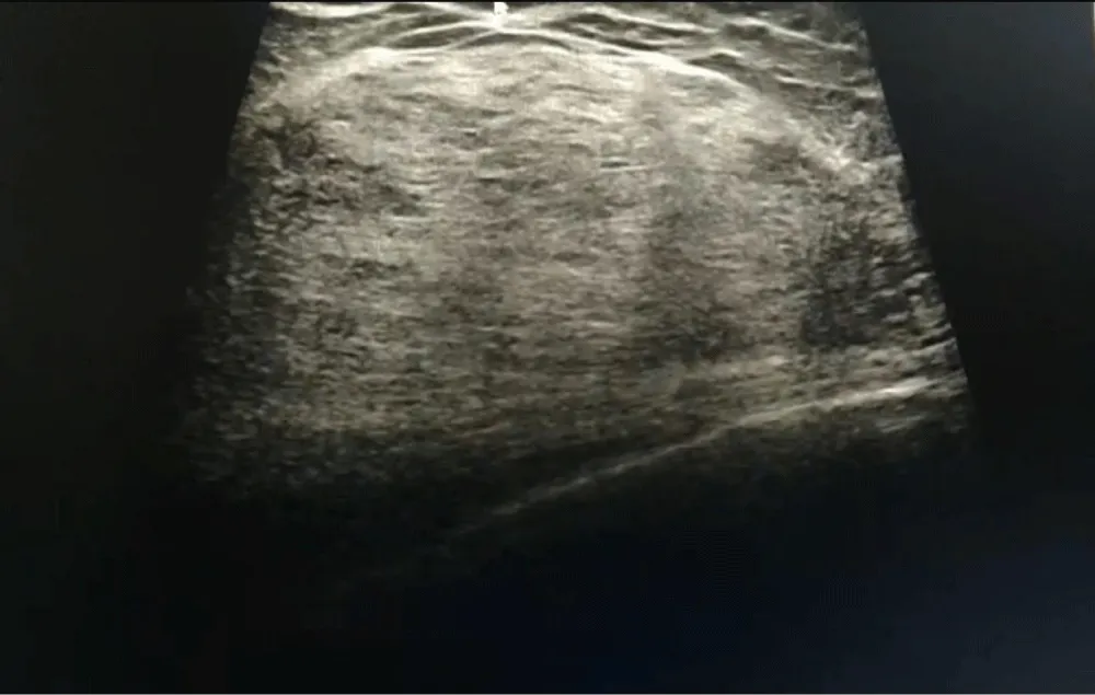 Giant Chondrolipoma of the Breast: A Rare Report of Breast within a Breast