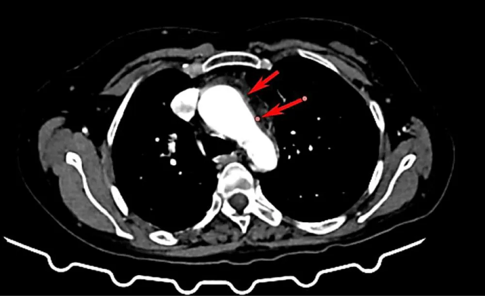 Coexistence of Takayasu Arteritis, Rheumatoid Arthritis and Autoimmune Hypothyroidism: A Case Report