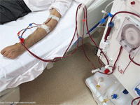 Popular Hemodialysis Articles